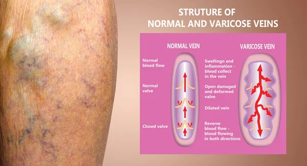 Varicose Veins Female Senior Legs Structure Normal Varicose Veins Concept — Stock Photo, Image