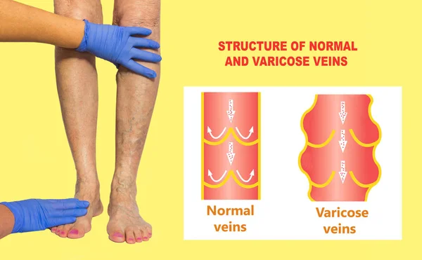 雌性长腿上的静脉曲张正常和静脉曲张的结构 大学生活 下肢血管检查因怀疑静脉不足 有色背景的女性腿 — 图库照片