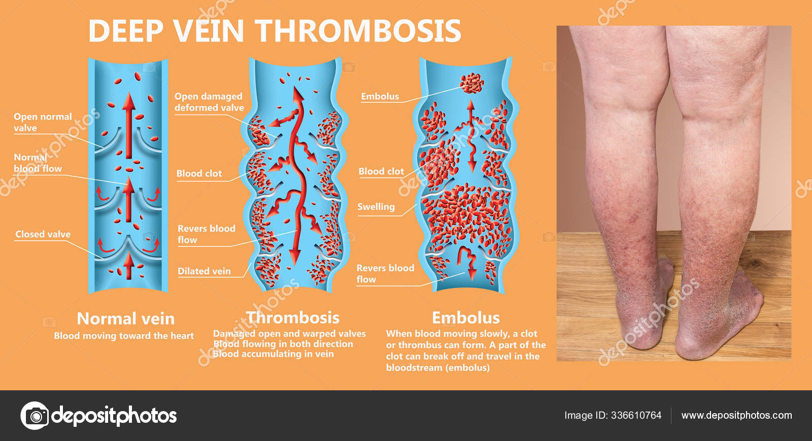 Thrombosis Normal Blood Flow Blood Clot Formation Clot Travels