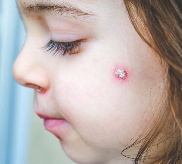 Chicken Pox Spot Details Face Close Spots Baby Face Side — Stock Photo, Image