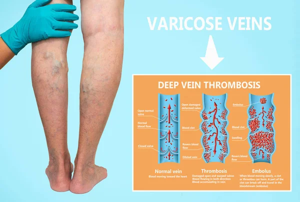 Varicose Veins Vein Thrombosis — Stock Photo, Image