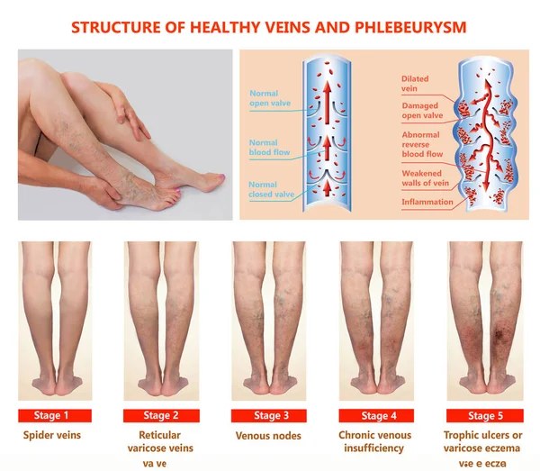 Thrombophlebitis. Deep Vein Thrombosis. Varicose veins. Phlebeurysm. Structure of normal veins and unhealthy vein