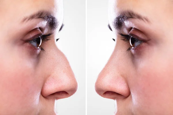 Woman Nose Plastic Surgery Red Green Arrows — Stock Photo, Image