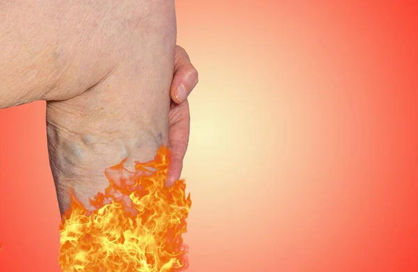 火の老婆の足の静脈瘤 静脈瘤 クモ状静脈 病気の概念 両手脚でシニアの年金受給者の女性 — ストック写真