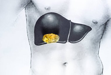 stone in the liver, a schematic image, a large gallstone, the result of gallstones. clipart