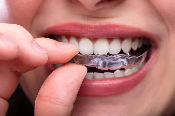 歯に透明アライナーを入れる女の手のクローズアップ — ストック写真