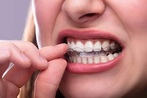 歯に透明アライナーを入れる女の手のクローズアップ — ストック写真