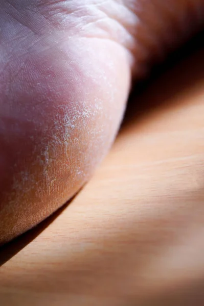 Closeup Image Heel Foot White Callus Image Medical Purposes — Stock Photo, Image