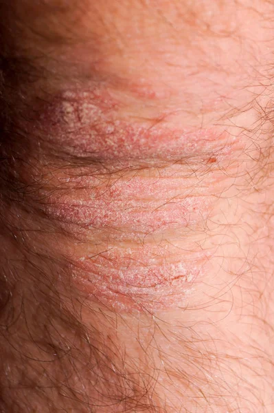 Psoriasis Dry Red White Irritation Skin Closeup Image Medical Purposes — Stock Photo, Image