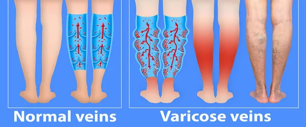 여자의 다리에 정맥류와 정맥류 정맥의 구조입니다 정맥류 혈전증 Dvt — 스톡 사진