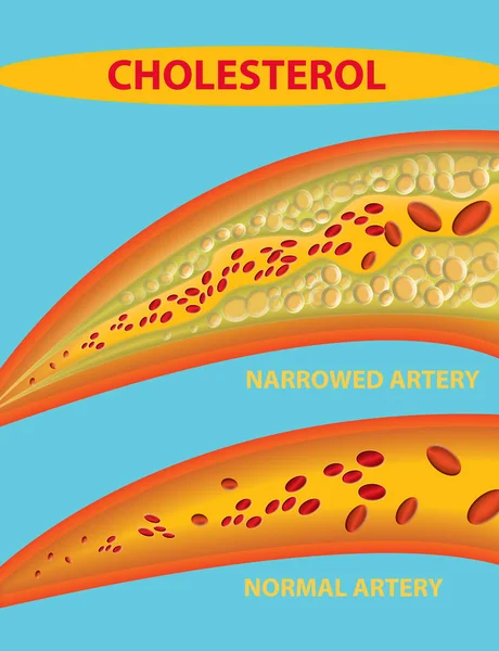 Cuerpo Sanguíneo Bloqueado Arteria Con Colesterol Que Acumula Una Ilustración —  Fotos de Stock