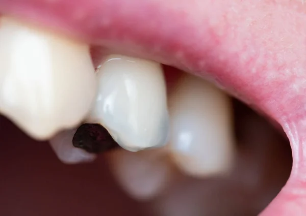 人の歯に封印を解く 歯の健康問題の概念 — ストック写真