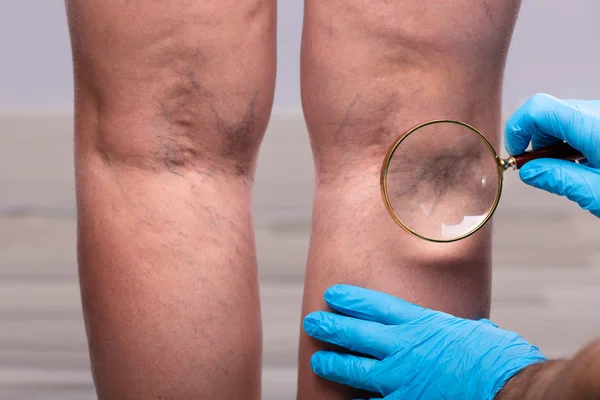 근접촬영 Surgeon Wearing Blue Surgical Gloves Examining Varicose Veins Magnifying — 스톡 사진