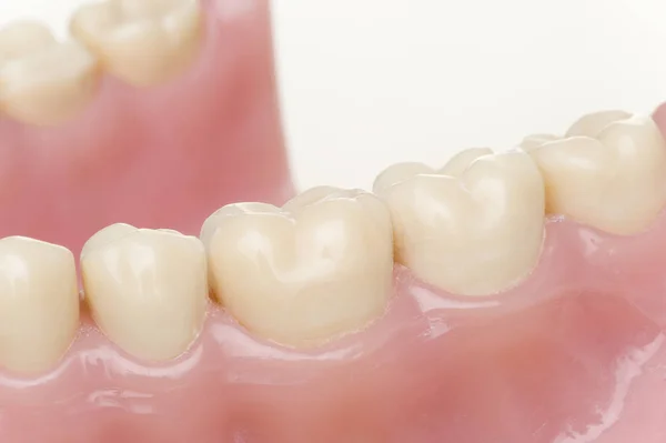 Modello Denti Con Impianto Dentale Apparecchio Ortodontico — Foto Stock