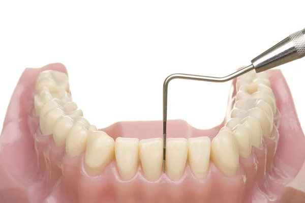 歯のインプラントと歯は白い部分に — ストック写真