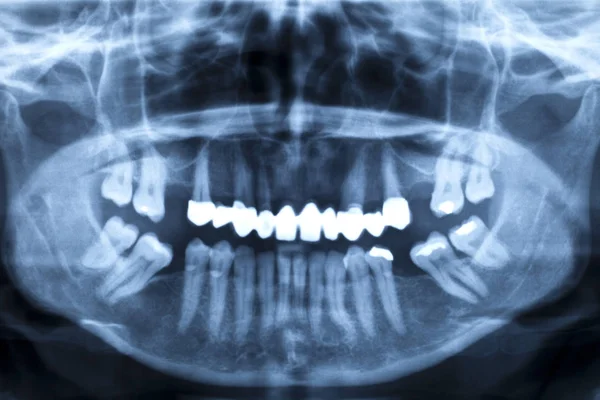 Mandíbula Adulto Com Dentes Defeituosos Radiografia — Fotografia de Stock