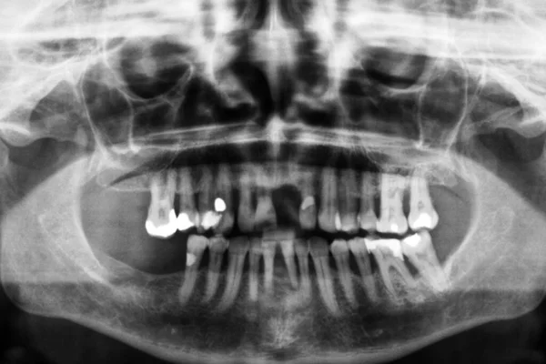 Mascella Adulto Con Denti Cattivi Nella Radiografia — Foto Stock