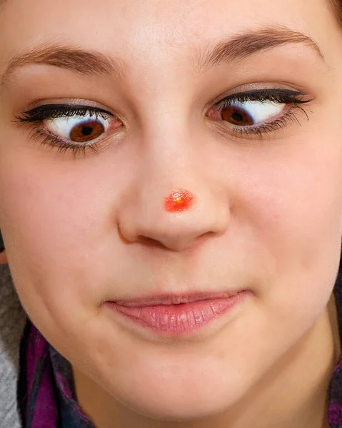 Large Pimples Nose — Stock Photo, Image