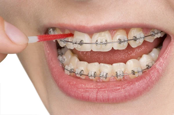 Close Woman Mouth Braces — Stock Photo, Image