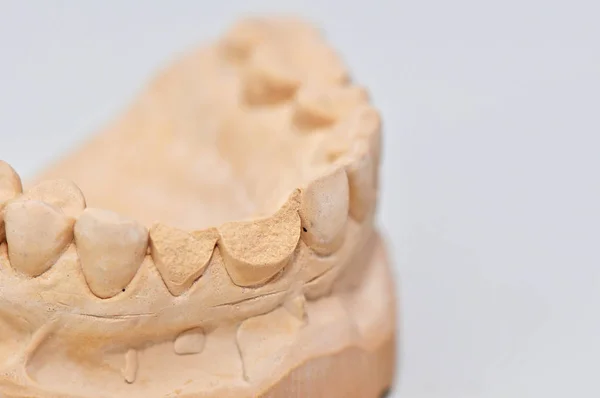 人間の歯の歯型 虫歯のモデル 白い背景に隔離された — ストック写真