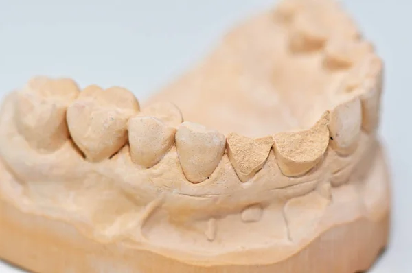 Nsan Dişlerindeki Diş Kalıbı Kapatın — Stok fotoğraf