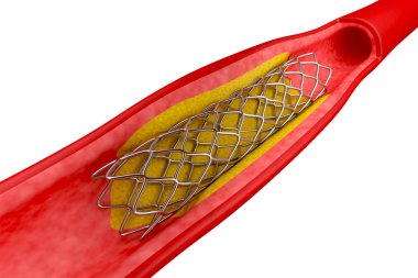 Stent in artery, helping for better blood flow clipart