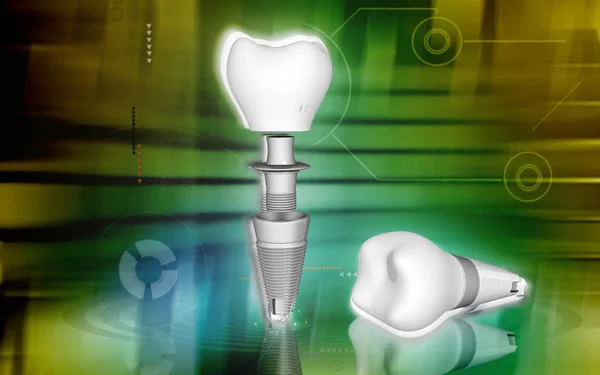 Ilustração Digital Implante Dentário Fundo Colorido — Fotografia de Stock