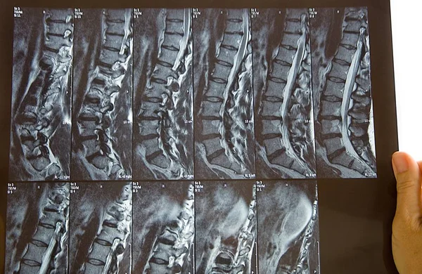 Radiografia Coluna Vertebral — Fotografia de Stock