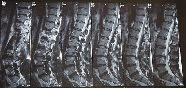 Ray Image Spine — Stock Photo, Image