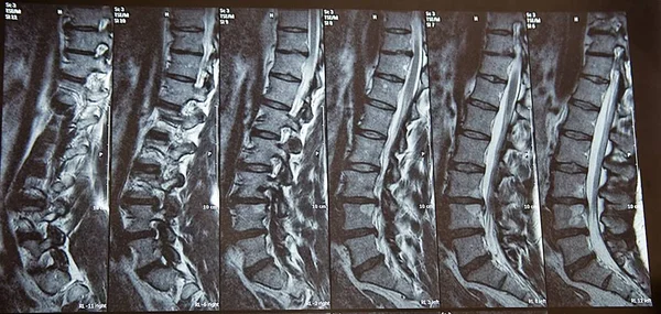 Ray Image Spine — Stock Photo, Image