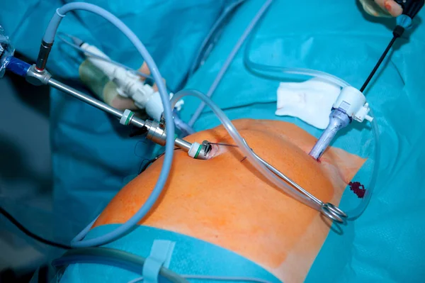 Cirurgiões Que Trabalham Paciente Teatro Operacional Minimamente Invasivo — Fotografia de Stock