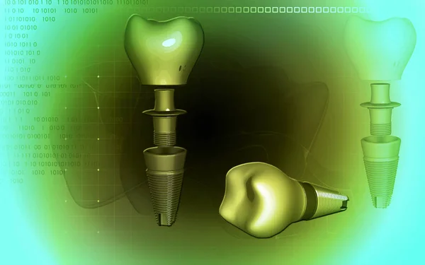 Digitale Illustration Zahnimplantat Farbigen Hintergrund — Stockfoto