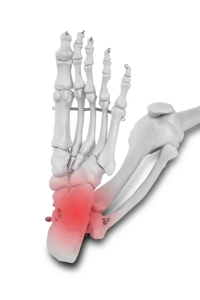 脚后跟和踝关节疼痛 疼痛概念 — 图库照片