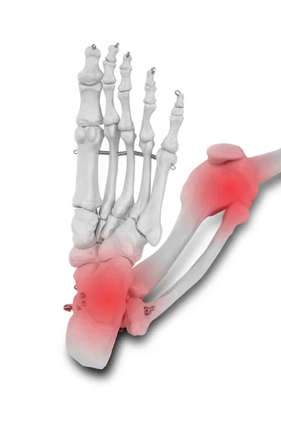 脚后跟和膝关节疼痛 疼痛概念 — 图库照片