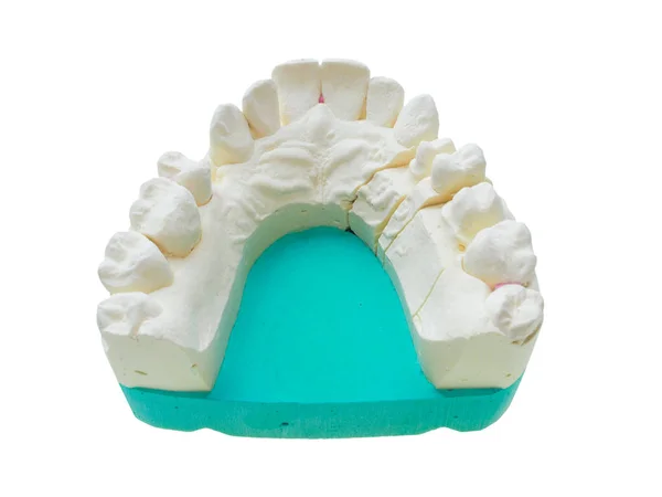 歯白で分離の否定的な歯科用印象から形成される肯定的な歯のモールド再現出演 — ストック写真