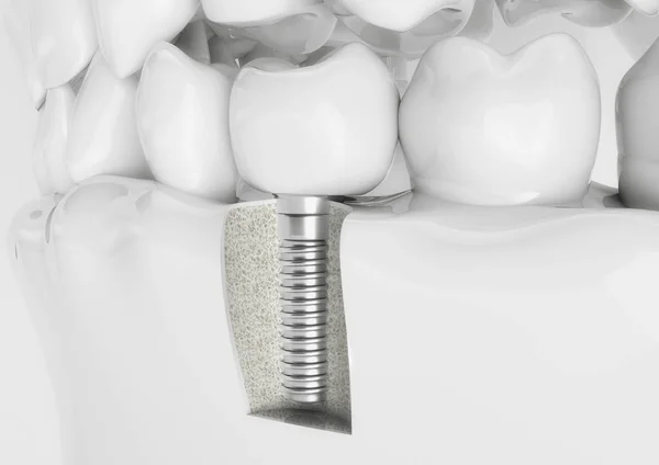 Impianto Dentale Con Corona Modello Denti — Foto Stock