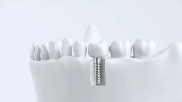 Implante Dental Con Corona Modelo Dientes —  Fotos de Stock