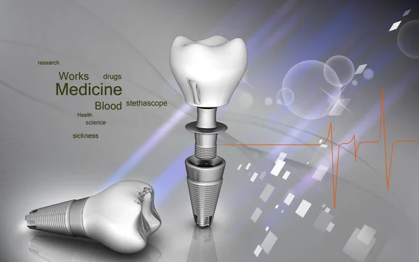 Цифрова Ілюстрація Стоматологічної Імплантації Кольоровому Фоні — стокове фото