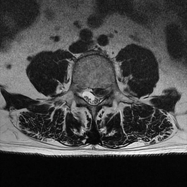 Ágyéki Porckorongsérv Mri — Stock Fotó