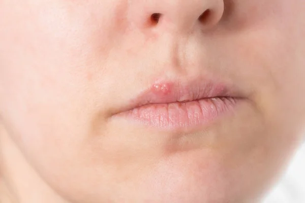 Labios Una Mujer Recibido Debido Virus Tipo Infección Herpes Labial —  Fotos de Stock