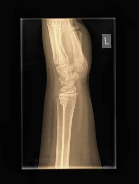 Yaşındaki Erkek Hastanın Bilek Röntgeni Distal Yarıçapı Dirsek Kemiği Kırıkları — Stok fotoğraf