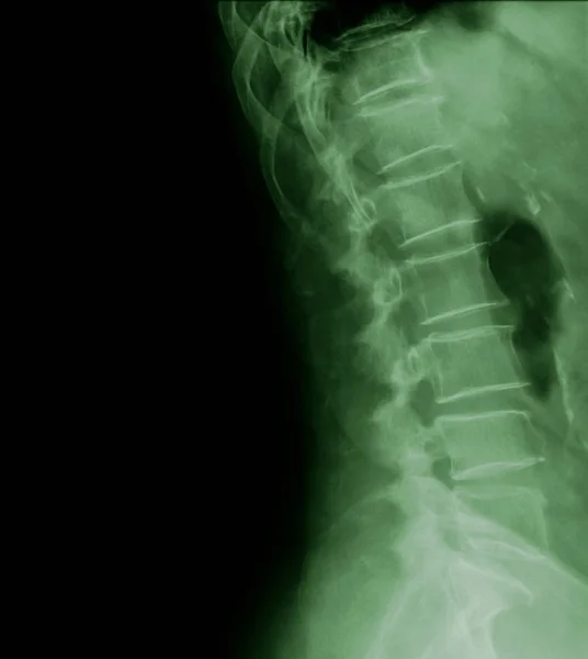 Ακτινογραφία Οσφυϊκής Μοίρας Σπονδυλικής Στήλης 77Χρονου Ασθενούς Πλευρική Όψη — Φωτογραφία Αρχείου