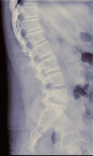 척추뼈 Ray — 스톡 사진