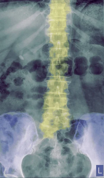 Ray Lumbar Spine Front View Year Old Patient — Stock Photo, Image