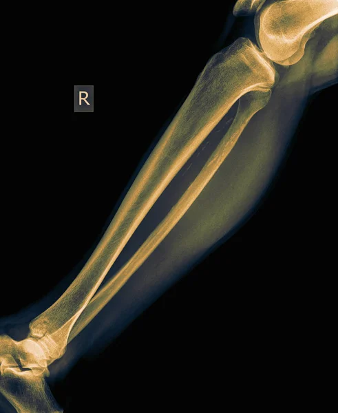 Radio Pierna Inferior Años Edad Con Vista Frontal Fraccionada Tibia — Foto de Stock