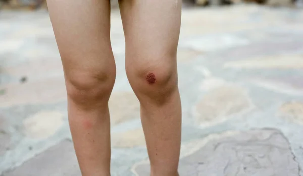 膝の上の小さな傷 — ストック写真