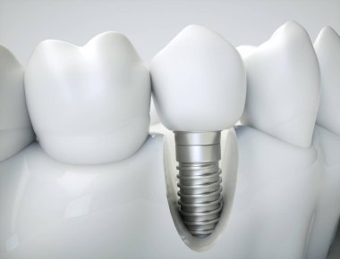 Dental implant on the example of a jaw model clipart