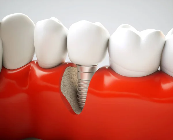 Implante Dental Ejemplo Modelo Mandíbula — Foto de Stock