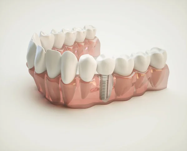 Impianto Dentale Sull Esempio Modello Mascella — Foto Stock