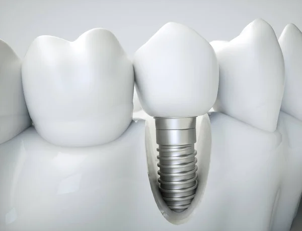 Implante Dental Ejemplo Modelo Mandíbula — Foto de Stock
